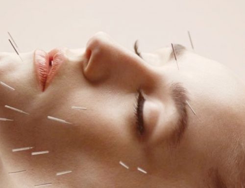 lifting facial con acupuntura